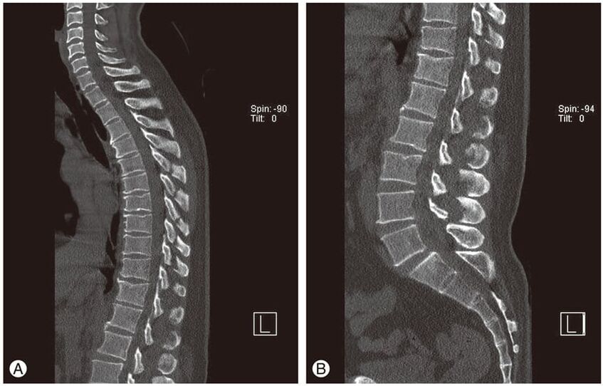 Deformace meziobratlových plotének na snímcích MRI u hrudní osteochondrózy