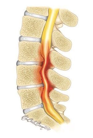 Při osteochondróze hrudní páteře dochází ke stlačení páteřního kanálu