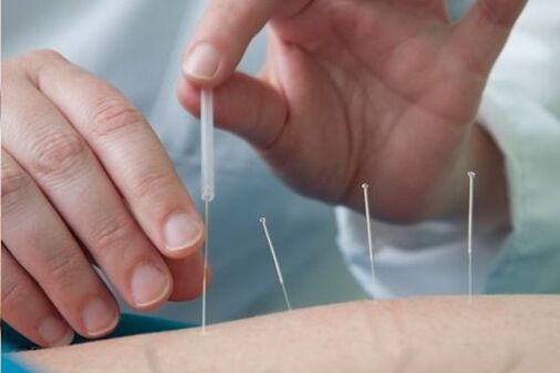 Akupunktura - metoda léčby bolesti v bederní oblasti způsobené osteochondrózou