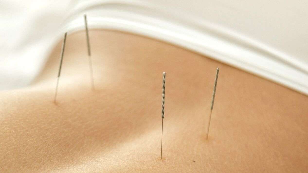 Akupunktura pomůže zbavit se bolesti dolní části zad